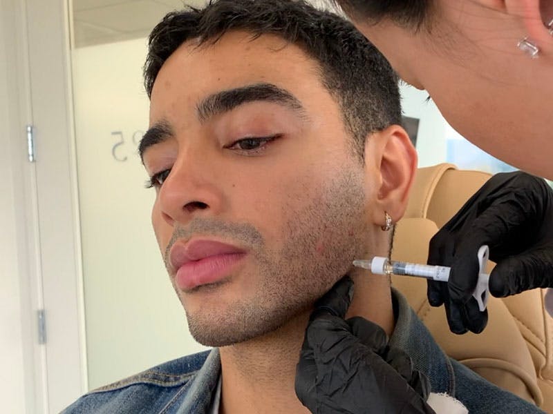 Filler Before & After Gallery - Patient 288013 - Image 6