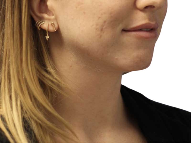 Filler Before & After Gallery - Patient 326909 - Image 1