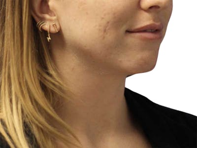 Filler Before & After Gallery - Patient 326909 - Image 1