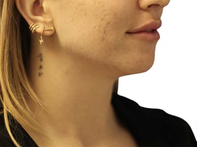 Filler Before & After Gallery - Patient 326909 - Image 2