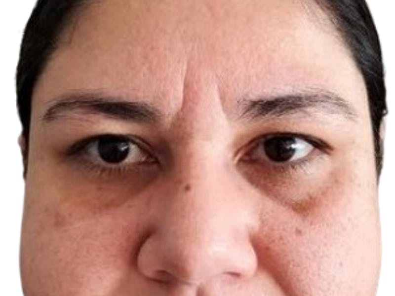 Filler Before & After Gallery - Patient 396121 - Image 1