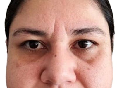 Filler Before & After Gallery - Patient 396121 - Image 1