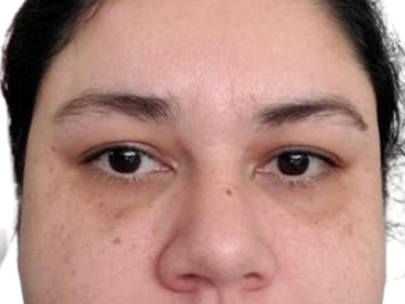 Filler Before & After Gallery - Patient 396121 - Image 2