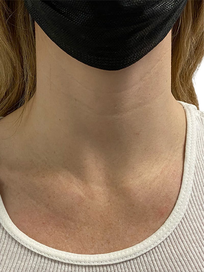 Filler Before & After Gallery - Patient 322132 - Image 1