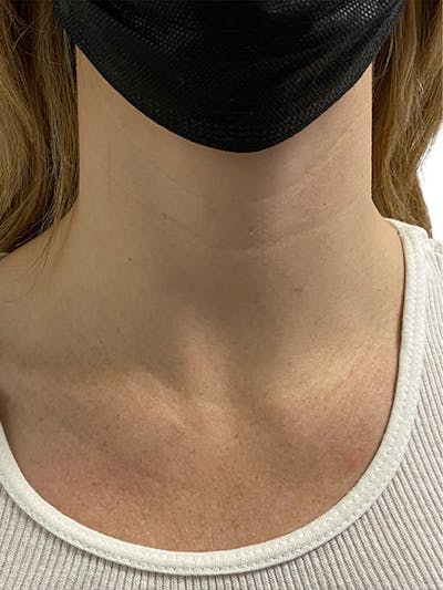 Filler Before & After Gallery - Patient 322132 - Image 1