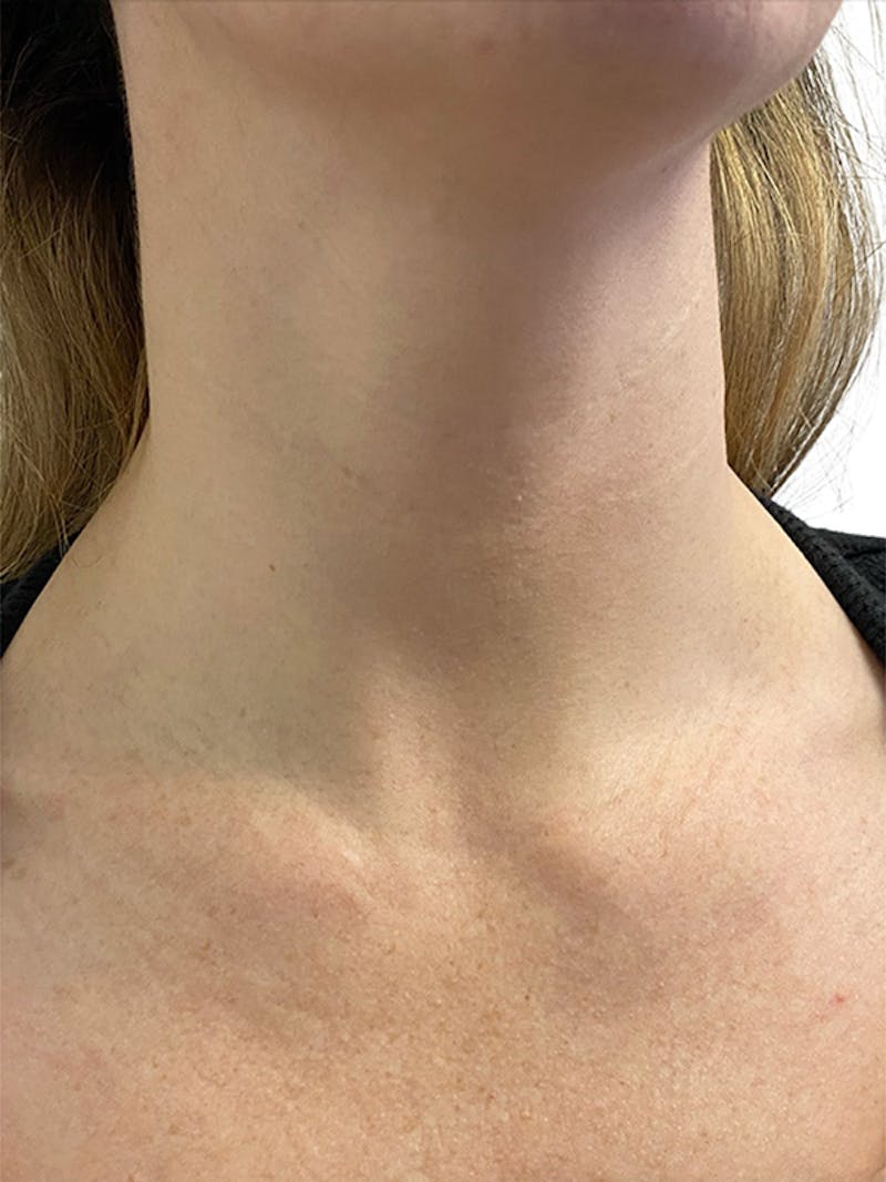 Filler Before & After Gallery - Patient 322132 - Image 2