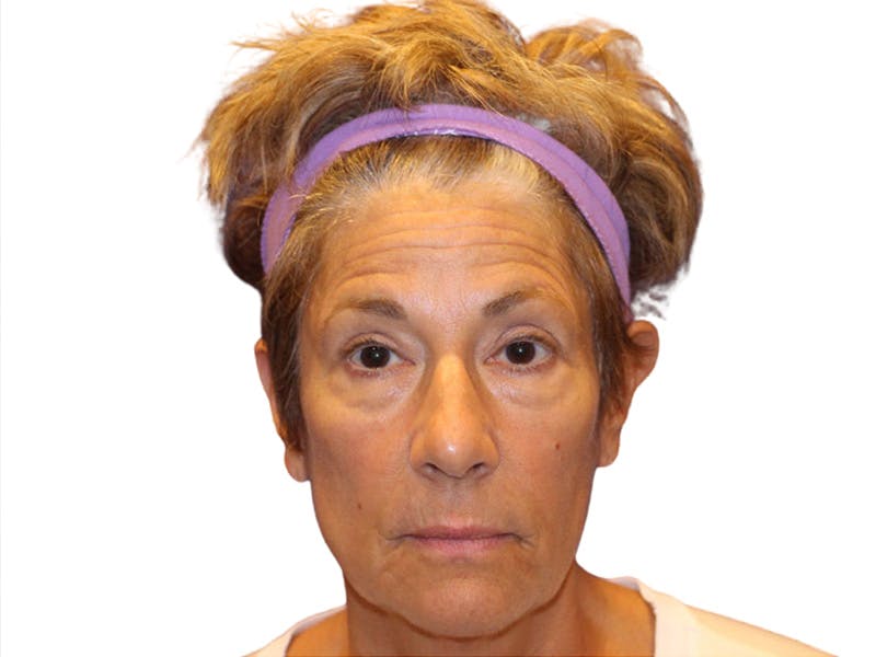 Filler Before & After Gallery - Patient 259707 - Image 1