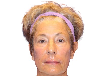 Filler Before & After Gallery - Patient 259707 - Image 2