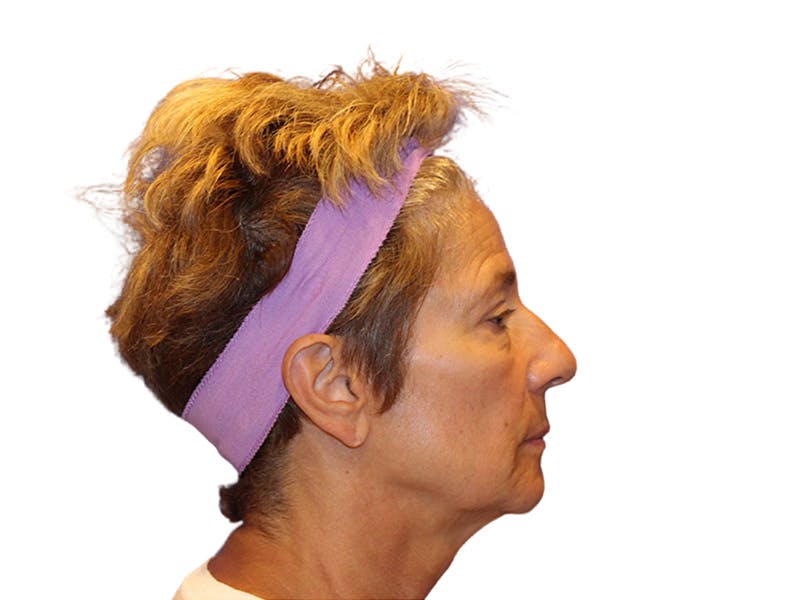 Filler Before & After Gallery - Patient 259707 - Image 3