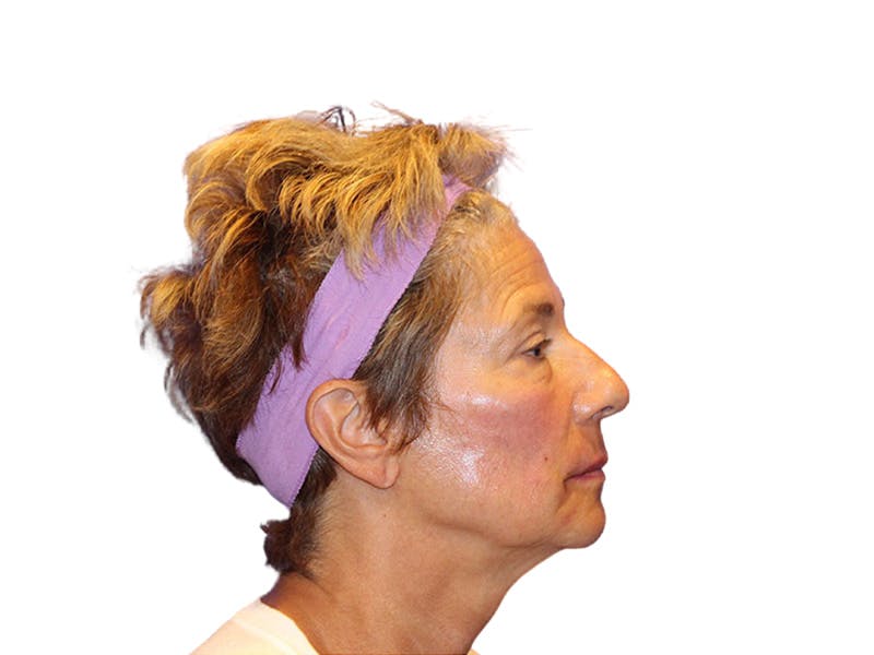 Filler Before & After Gallery - Patient 259707 - Image 4