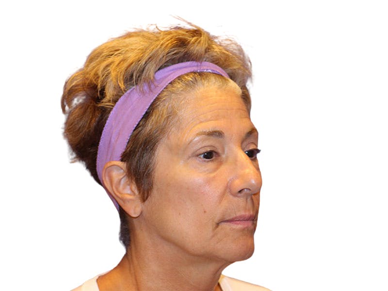 Filler Before & After Gallery - Patient 259707 - Image 5