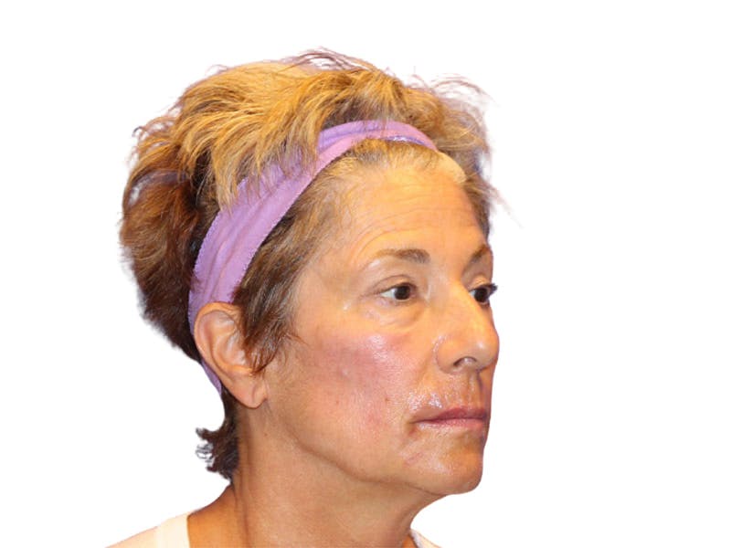 Filler Before & After Gallery - Patient 259707 - Image 6