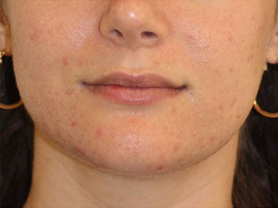 Filler Before & After Gallery - Patient 204708 - Image 1