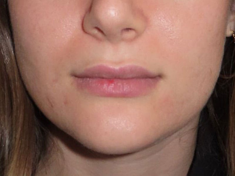 Filler Before & After Gallery - Patient 204708 - Image 2