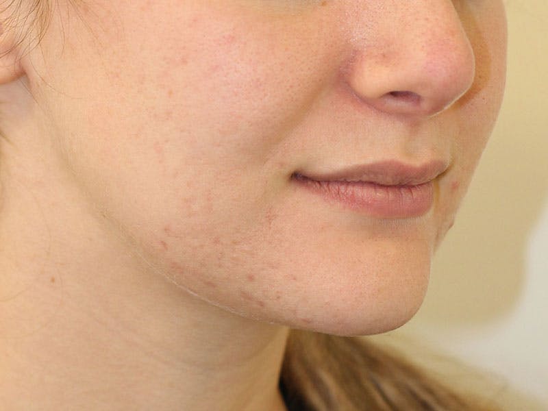 Filler Before & After Gallery - Patient 204708 - Image 3