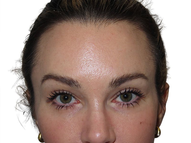 Filler Before & After Gallery - Patient 191736 - Image 1