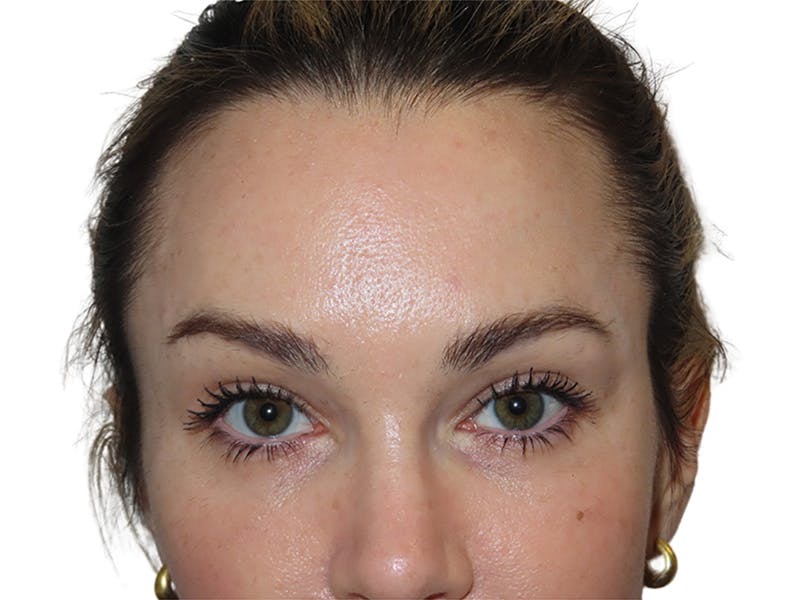 Filler Before & After Gallery - Patient 191736 - Image 2