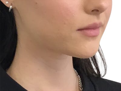 Filler Before & After Gallery - Patient 199731 - Image 1