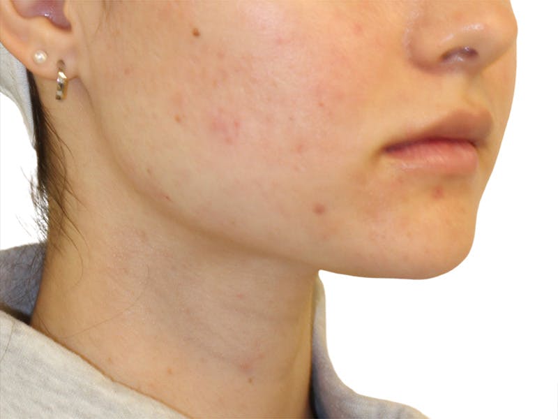 Filler Before & After Gallery - Patient 199731 - Image 2