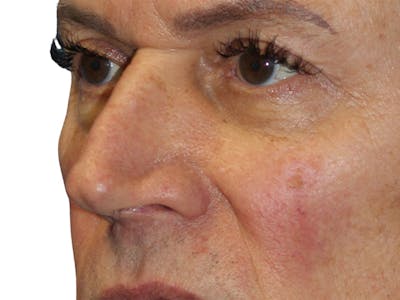 Filler Before & After Gallery - Patient 370148 - Image 1