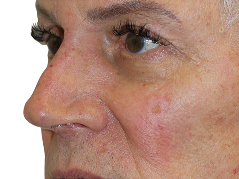 Filler Before & After Gallery - Patient 370148 - Image 2