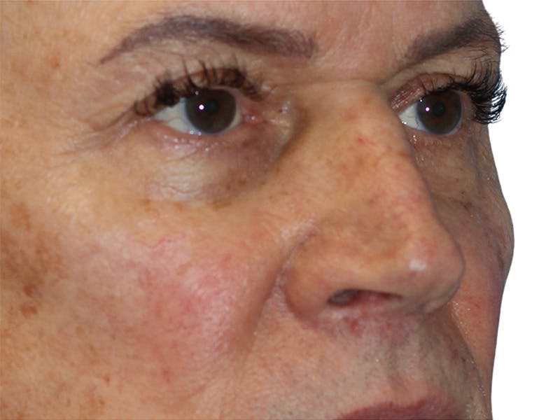 Filler Before & After Gallery - Patient 370148 - Image 3