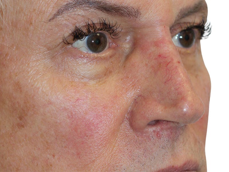 Filler Before & After Gallery - Patient 370148 - Image 4