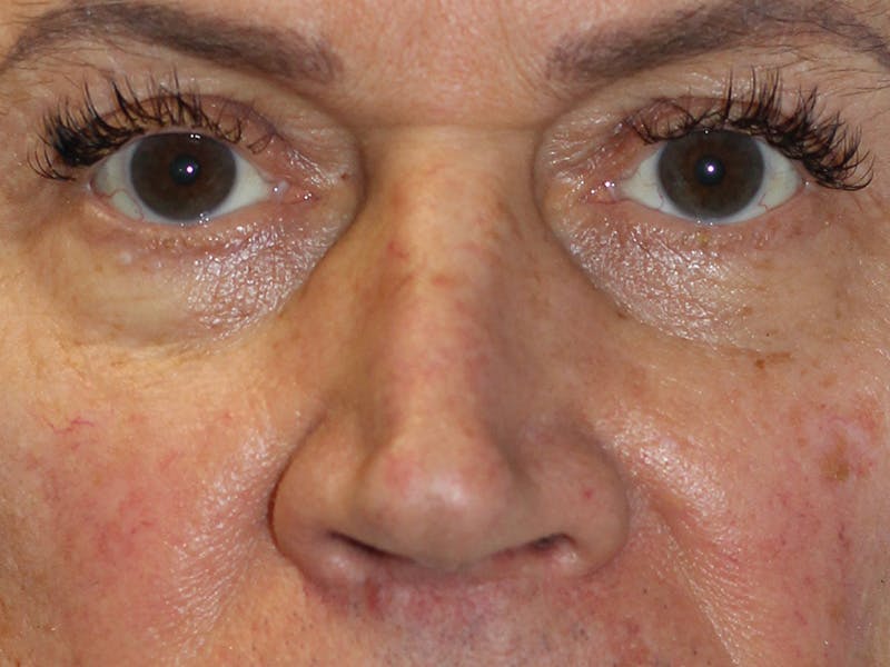 Filler Before & After Gallery - Patient 370148 - Image 5