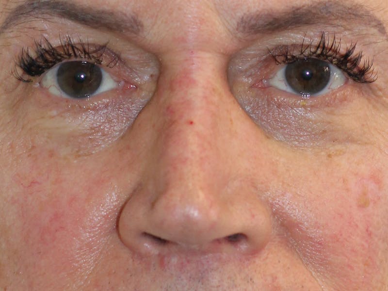Filler Before & After Gallery - Patient 370148 - Image 6