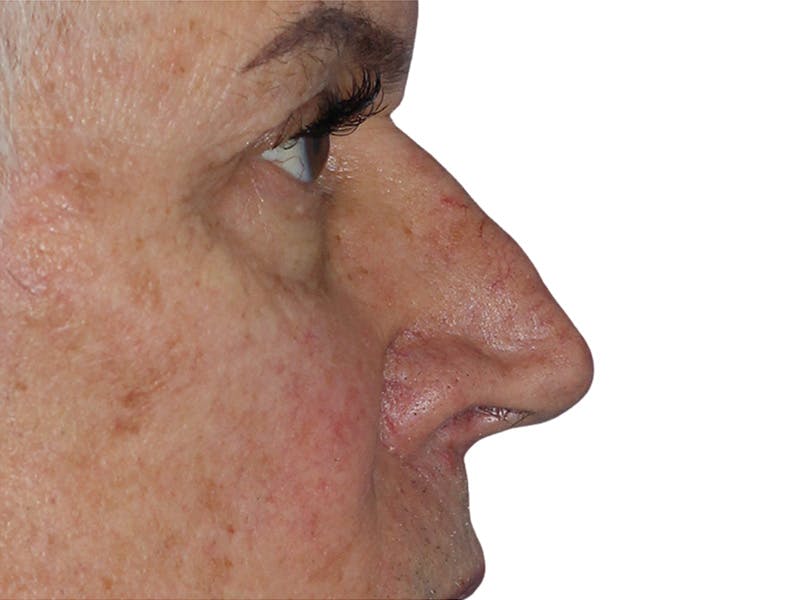Filler Before & After Gallery - Patient 370148 - Image 7