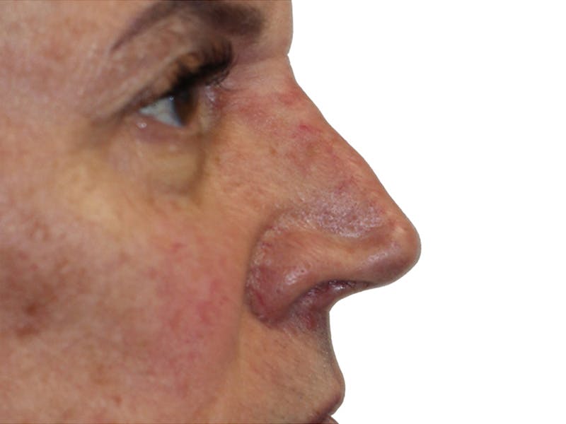 Filler Before & After Gallery - Patient 370148 - Image 8