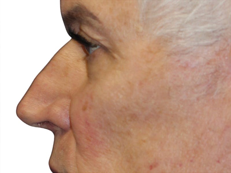 Filler Before & After Gallery - Patient 370148 - Image 9