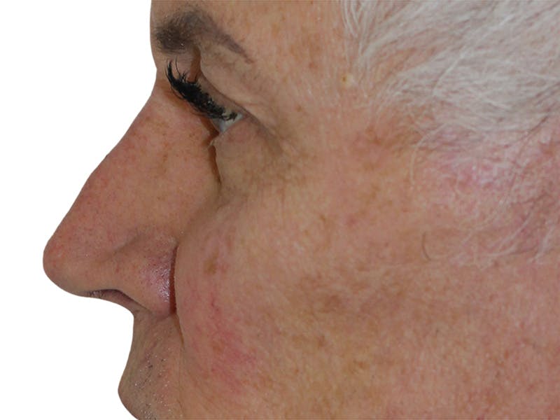 Filler Before & After Gallery - Patient 370148 - Image 10