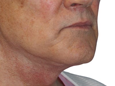 Filler Before & After Gallery - Patient 133861 - Image 1