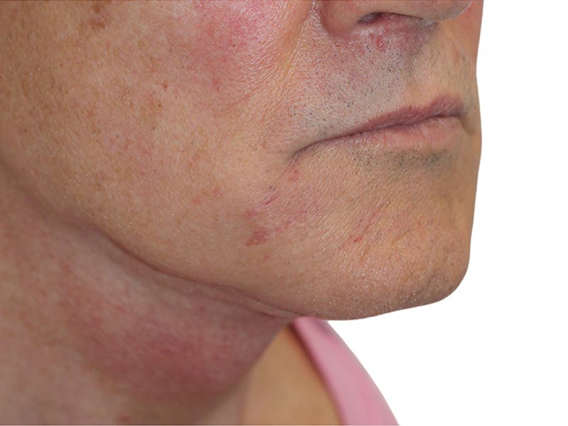 Filler Before & After Gallery - Patient 133861 - Image 2
