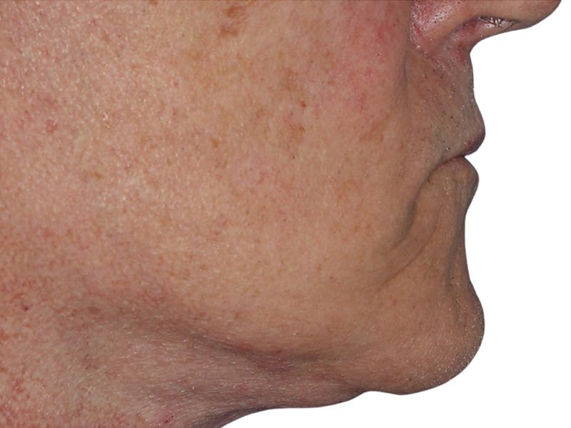 Filler Before & After Gallery - Patient 133861 - Image 3