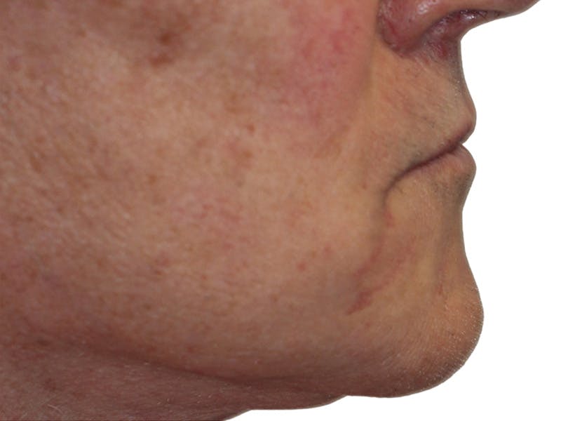 Filler Before & After Gallery - Patient 133861 - Image 4