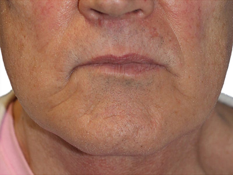 Filler Before & After Gallery - Patient 133861 - Image 5