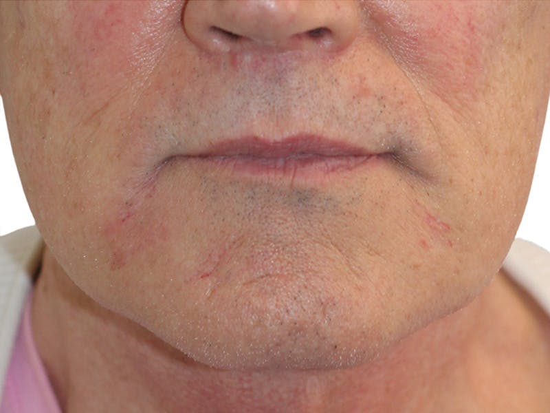 Filler Before & After Gallery - Patient 133861 - Image 6