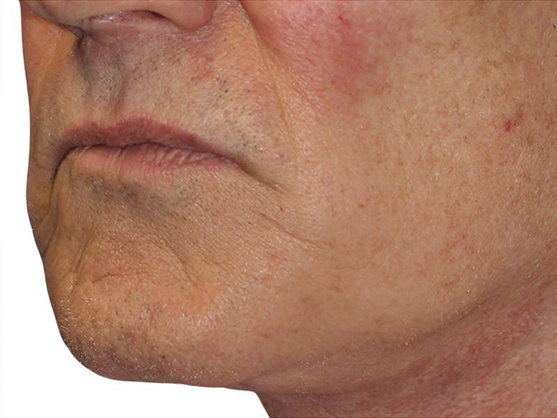 Filler Before & After Gallery - Patient 133861 - Image 7