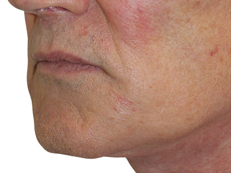 Filler Before & After Gallery - Patient 133861 - Image 8