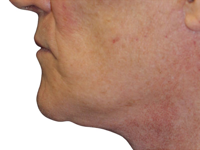 Filler Before & After Gallery - Patient 133861 - Image 9