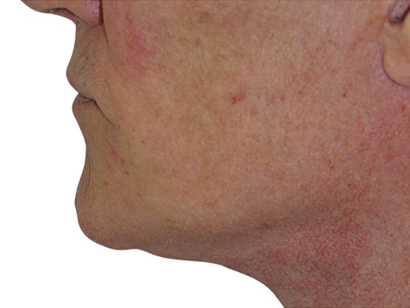 Filler Before & After Gallery - Patient 133861 - Image 10