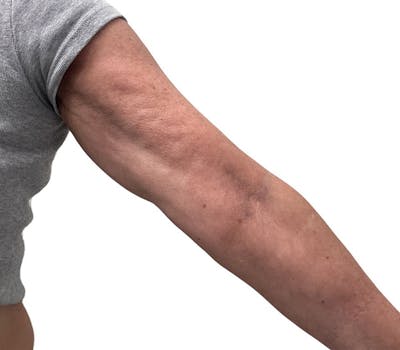 Sofwave Before & After Gallery - Patient 166734 - Image 1