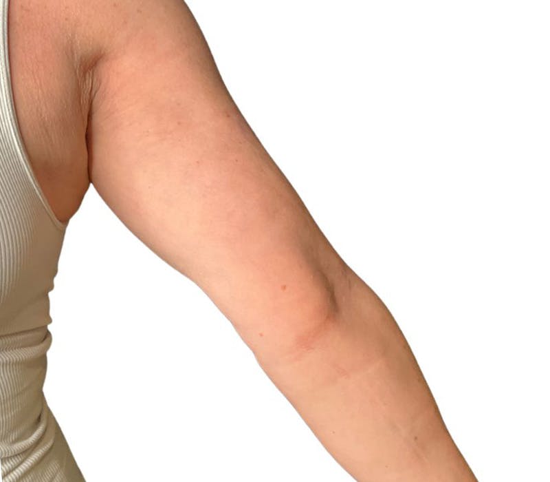 Sofwave Before & After Gallery - Patient 166734 - Image 2