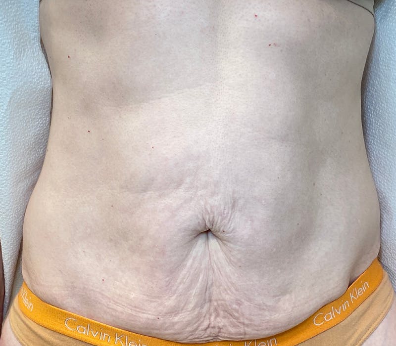 Sofwave Before & After Gallery - Patient 210086 - Image 1