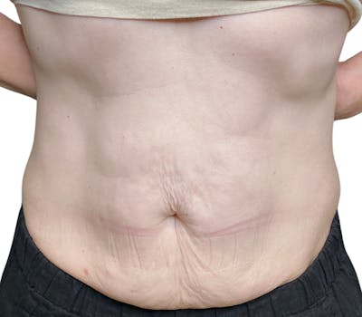 Sofwave Before & After Gallery - Patient 210086 - Image 2