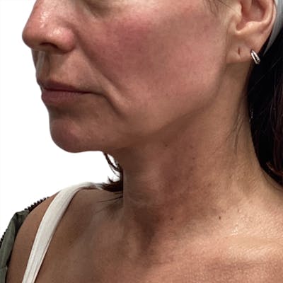 Sofwave Before & After Gallery - Patient 310031 - Image 1