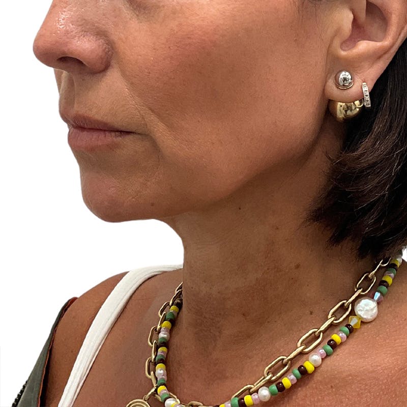 Sofwave Before & After Gallery - Patient 310031 - Image 2