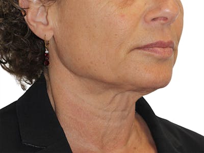 Sofwave Before & After Gallery - Patient 414496 - Image 1